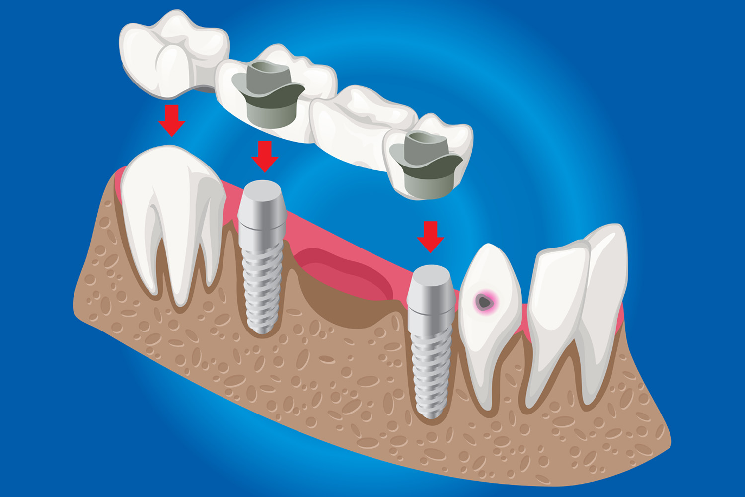 dental crown replacement in Hadapsar