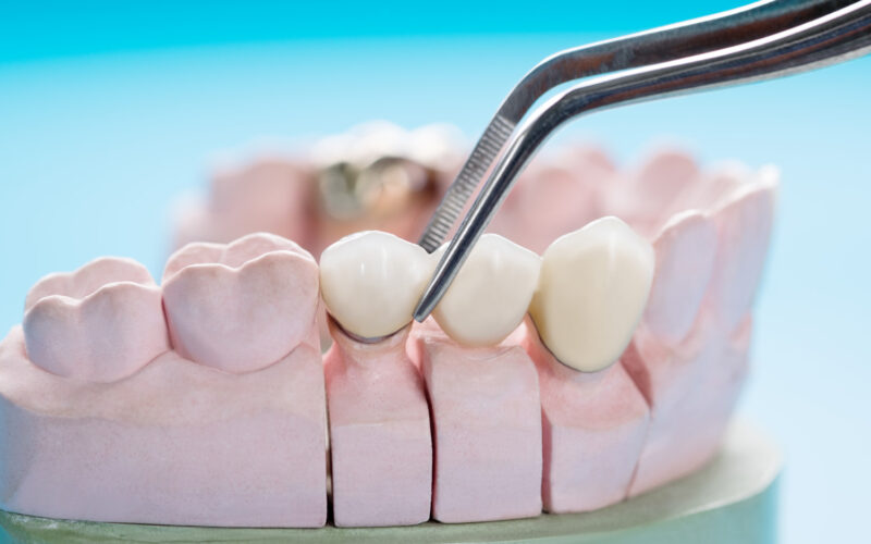 dental crowns and bridges in Hadapsar