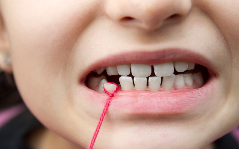 wisdom tooth extraction in Hadapsar