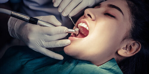 Best Root Canal Treatment in Pune Best Root Canal Treatment in Pune