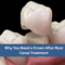 Why You Need a Crown After Root Canal Treatment | Dr. Rohini Lahane