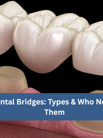 Dental Bridges: Types & Who Needs Them | Restore Your Smile