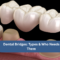 Dental Bridges: Types & Who Needs Them | Restore Your Smile