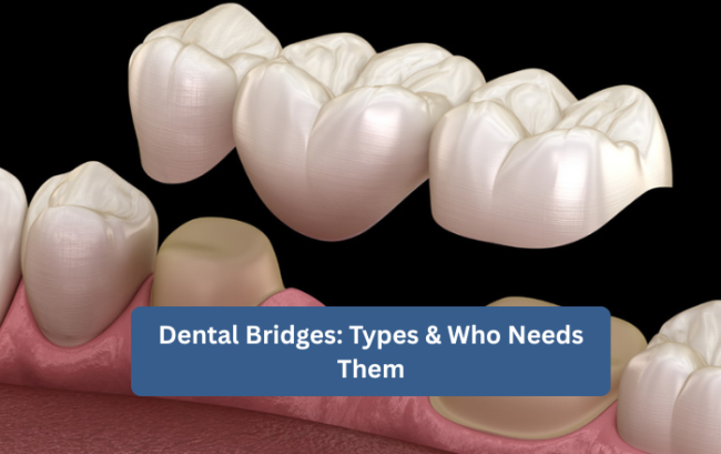 Dental Bridges: Types & Who Needs Them | Restore Your Smile Dental Bridges: Types & Who Needs Them | Restore Your Smile