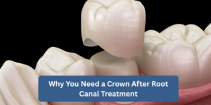 Why You Need a Crown After Root Canal Treatment